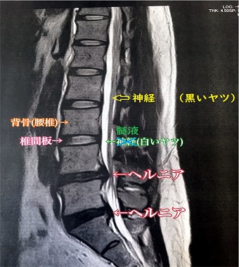 腰椎椎間板ヘルニアのMRI画像