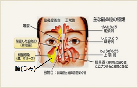 副鼻腔に膿が溜まった蓄膿症の画像