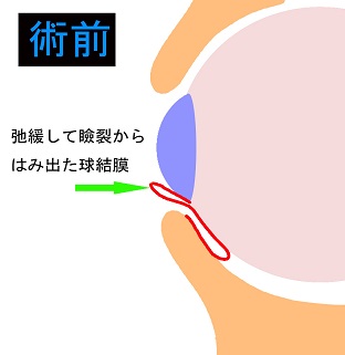 弛緩して瞼裂からはみでた球結膜の画像