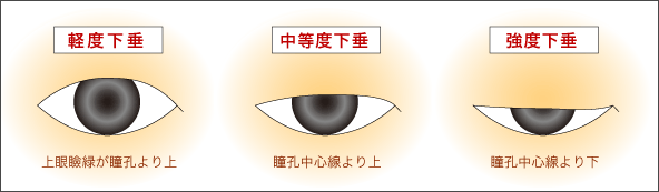 軽度・中等度・強度の眼瞼下垂の比較画像