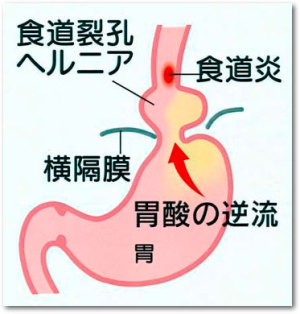 食道裂孔ヘルニアと逆流性食道炎の関係を表した画像