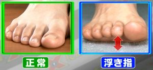 正常な足指と浮き指の画像
