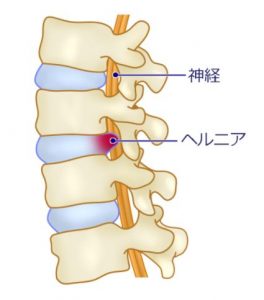 腰椎椎間板ヘルニアの画像