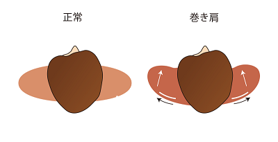 正常な人と巻き肩の人を示した画像
