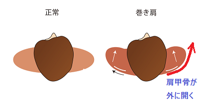 正常な人と巻き肩の人の比較画像