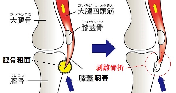 オスグッドのメカニズム画像