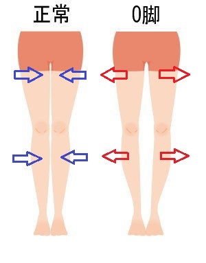 正常な脚とO脚の脚の画像