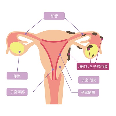 子宮内膜症の図