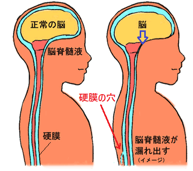 硬膜に穴があいて髄液が漏れ出している人の画像