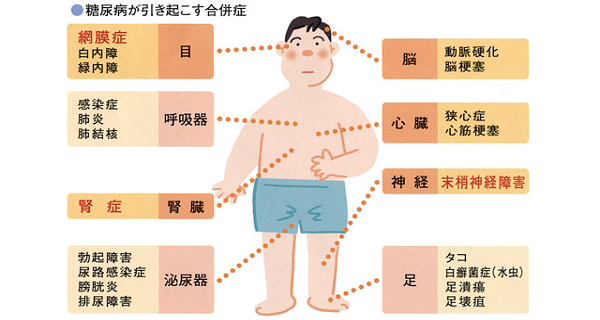 糖尿病が引き起こす合併症を示した図の画像