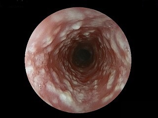 カンジダ菌の内視鏡写真画像