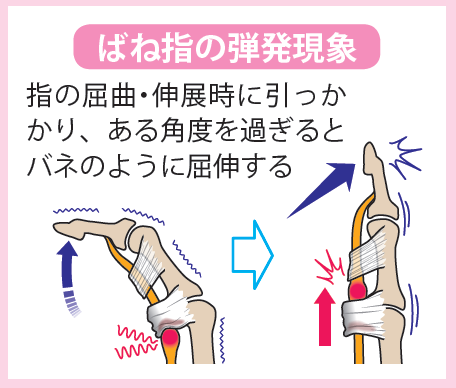 ばね指の弾発現象を示した画像