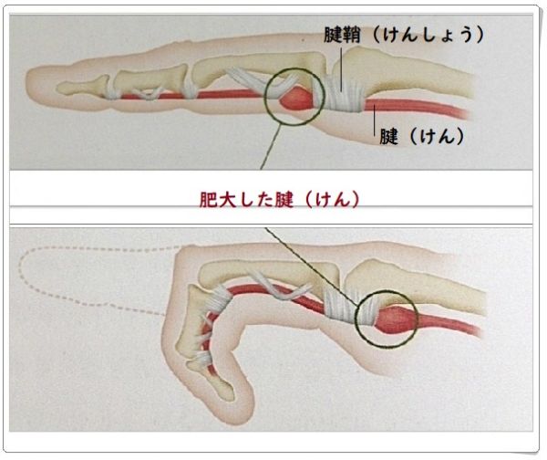 肥大した腱を示した画像