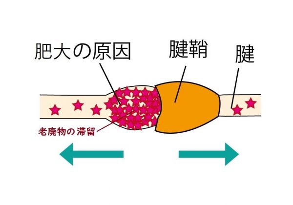 腱の腫れの原因を表した画像