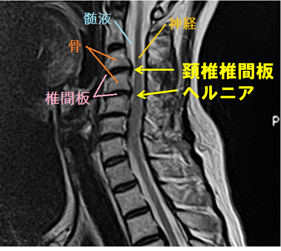 頚椎ヘルニアのMRI画像