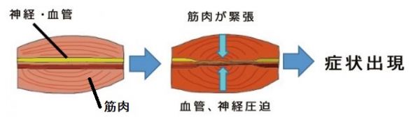 筋肉の中を通る神経や血管が圧迫されている様子を示した画像