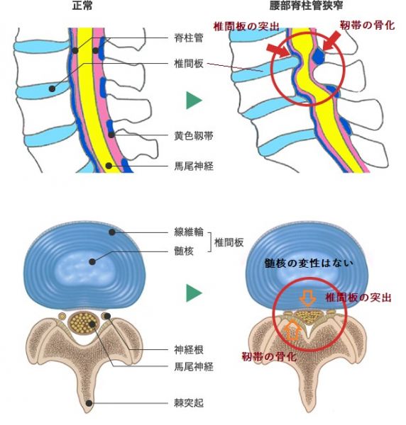 脊柱管狭窄症の病態を示した画像