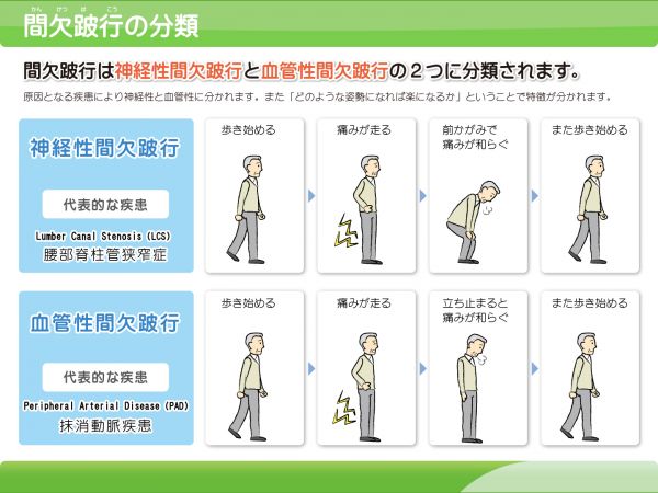 間欠跛行の分類を示した画像