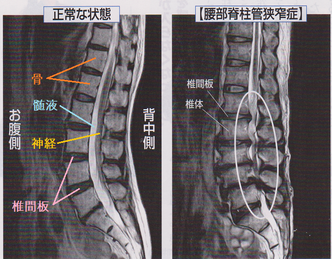 腰部脊柱管狭窄のMRI画像