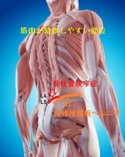 腰椎椎間板ヘルニアと腰部脊柱管狭窄症の筋肉が緊張する部位を示した画像