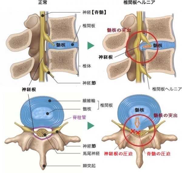椎間板ヘルニアの病態を示した画像