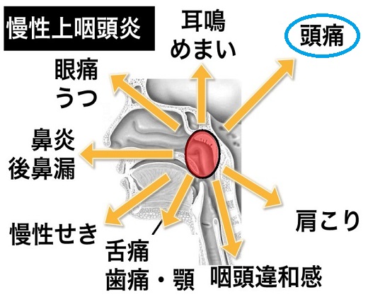 慢性上咽頭炎の症状を示した画像