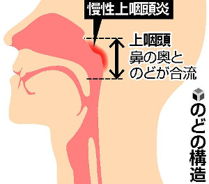 慢性上咽頭炎が起こる部位を示した画像