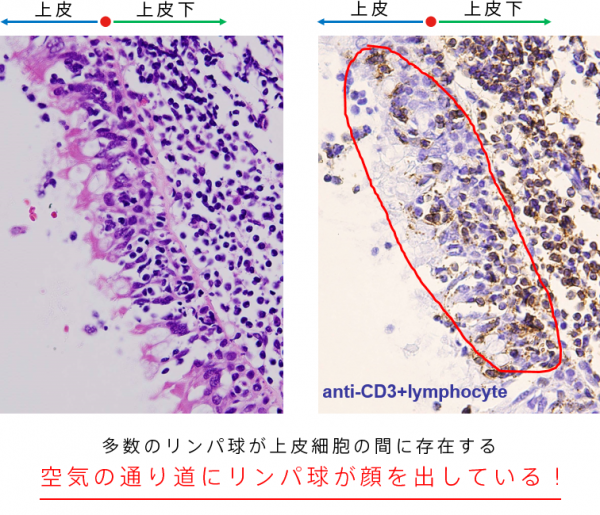 リンパ球が上皮細胞間に多数存在することを示す画像