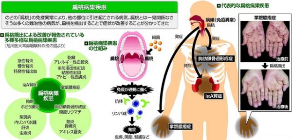 扁桃病巣疾患のメカニズムを表す画像